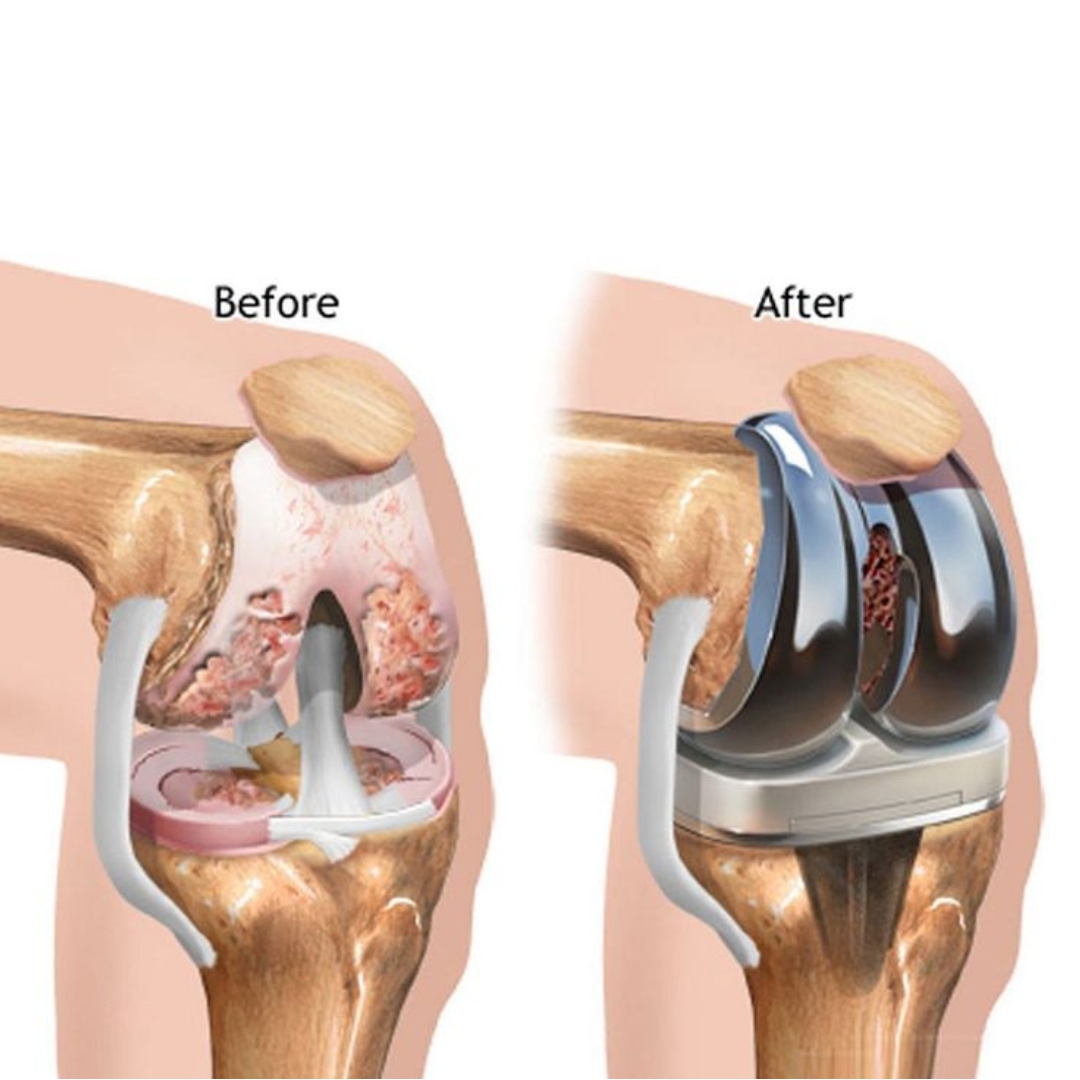 How Long Does a Knee Replacement Last?